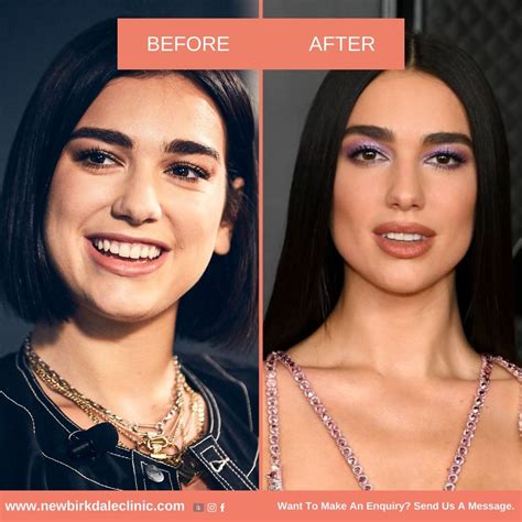 dua lipa lip filler.